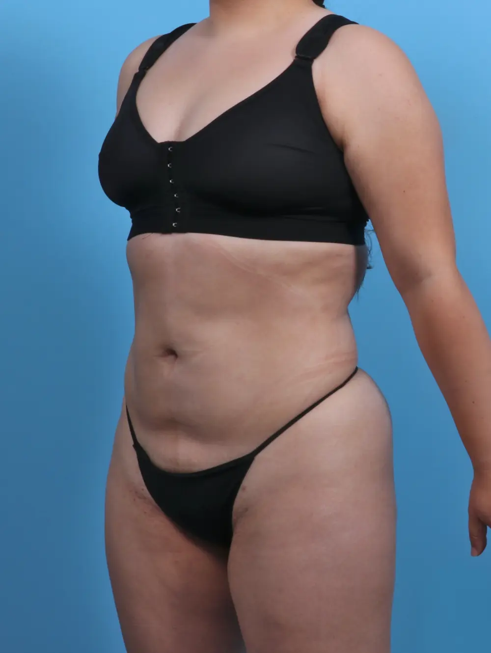 Liposuction Patient Photo - Case 28452 - after view-1