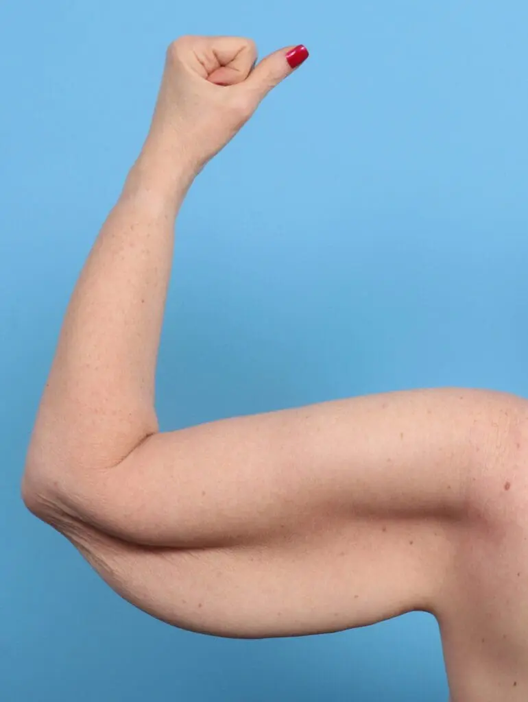 Arm Lift - Case 28470 - Before