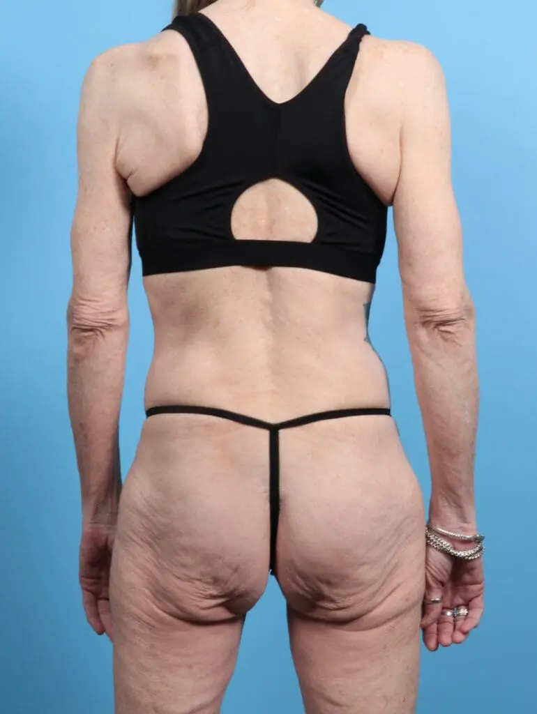 Body Lift - Case 28508 - Before