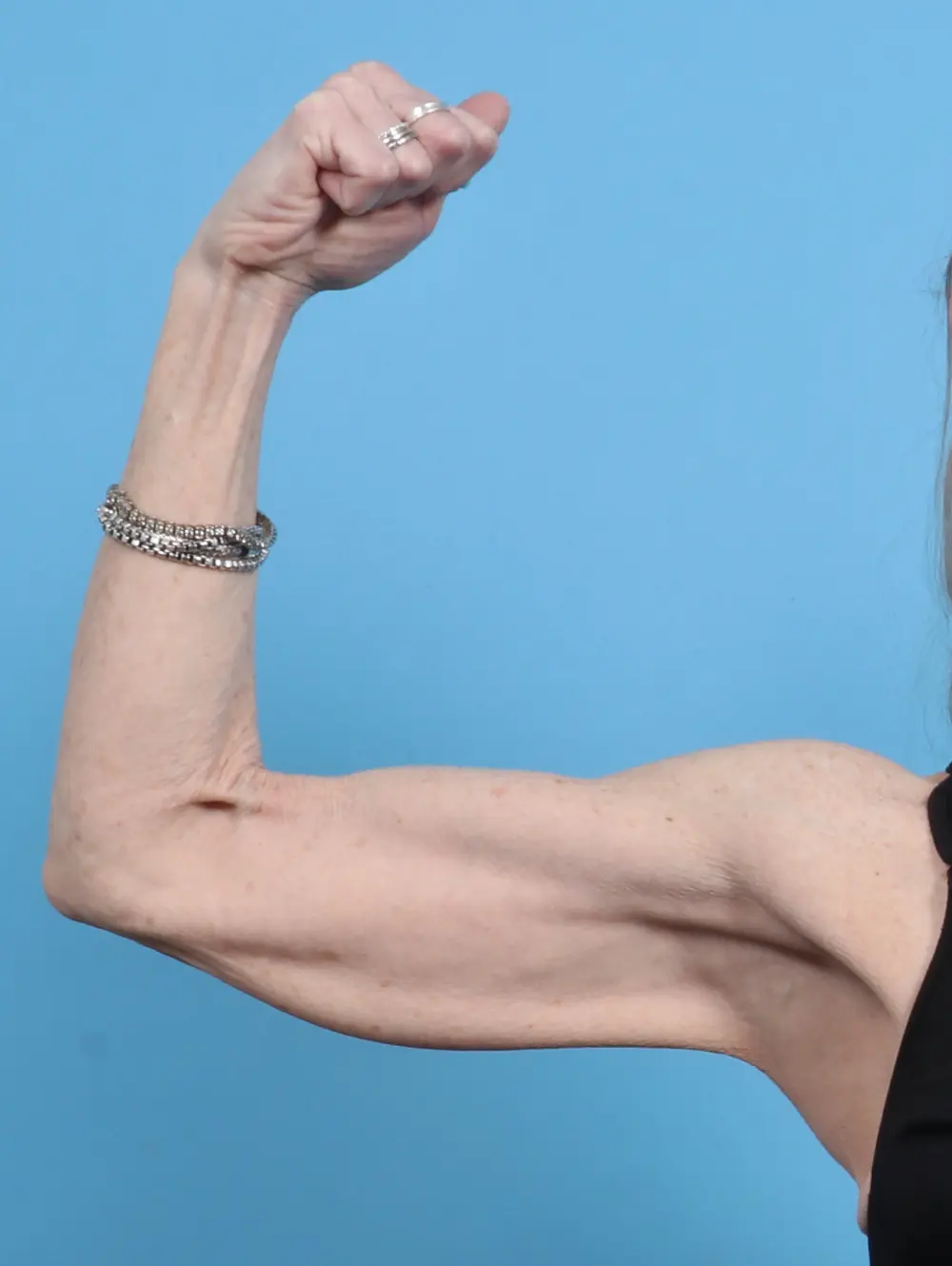 Arm Lift Patient Photo - Case 28512 - before view-1