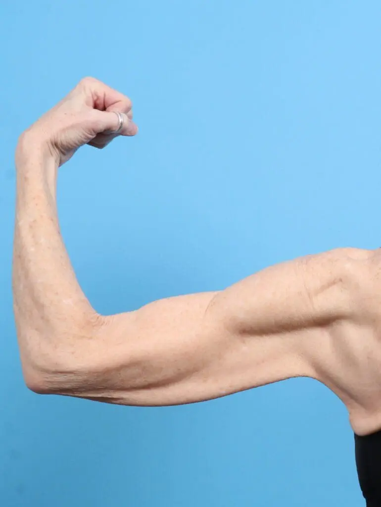 Arm Lift - Case 28512 - Before