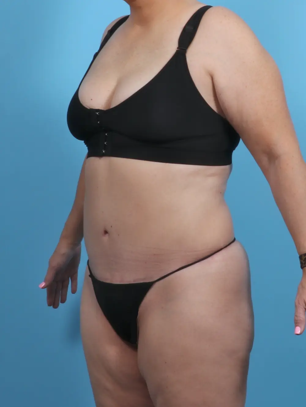 Tummy Tuck Patient Photo - Case 28518 - after view-1