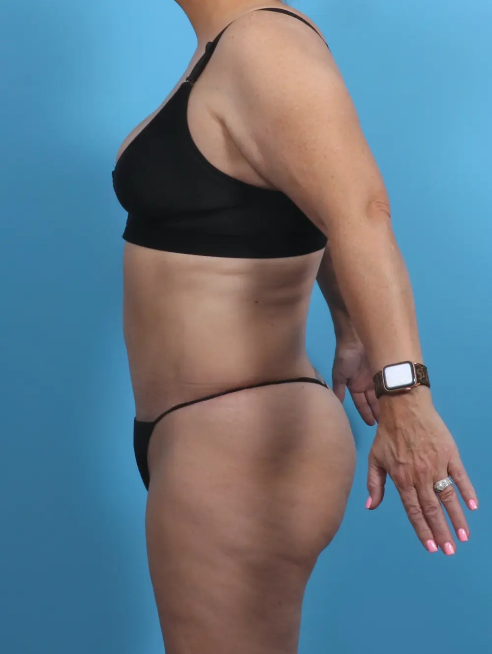 Tummy Tuck Patient Photo - Case 28518 - after view-2