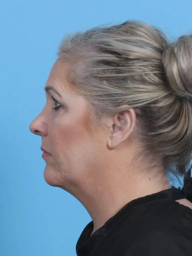 Rhinoplasty - Case 28526 - After