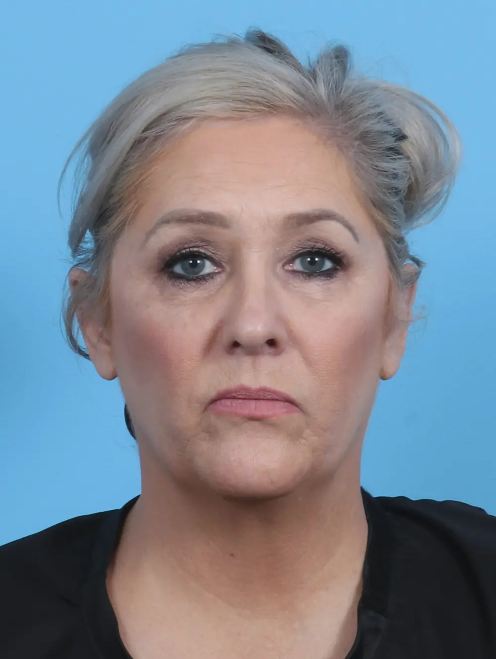 Rhinoplasty Patient Photo - Case 28526 - after view-2