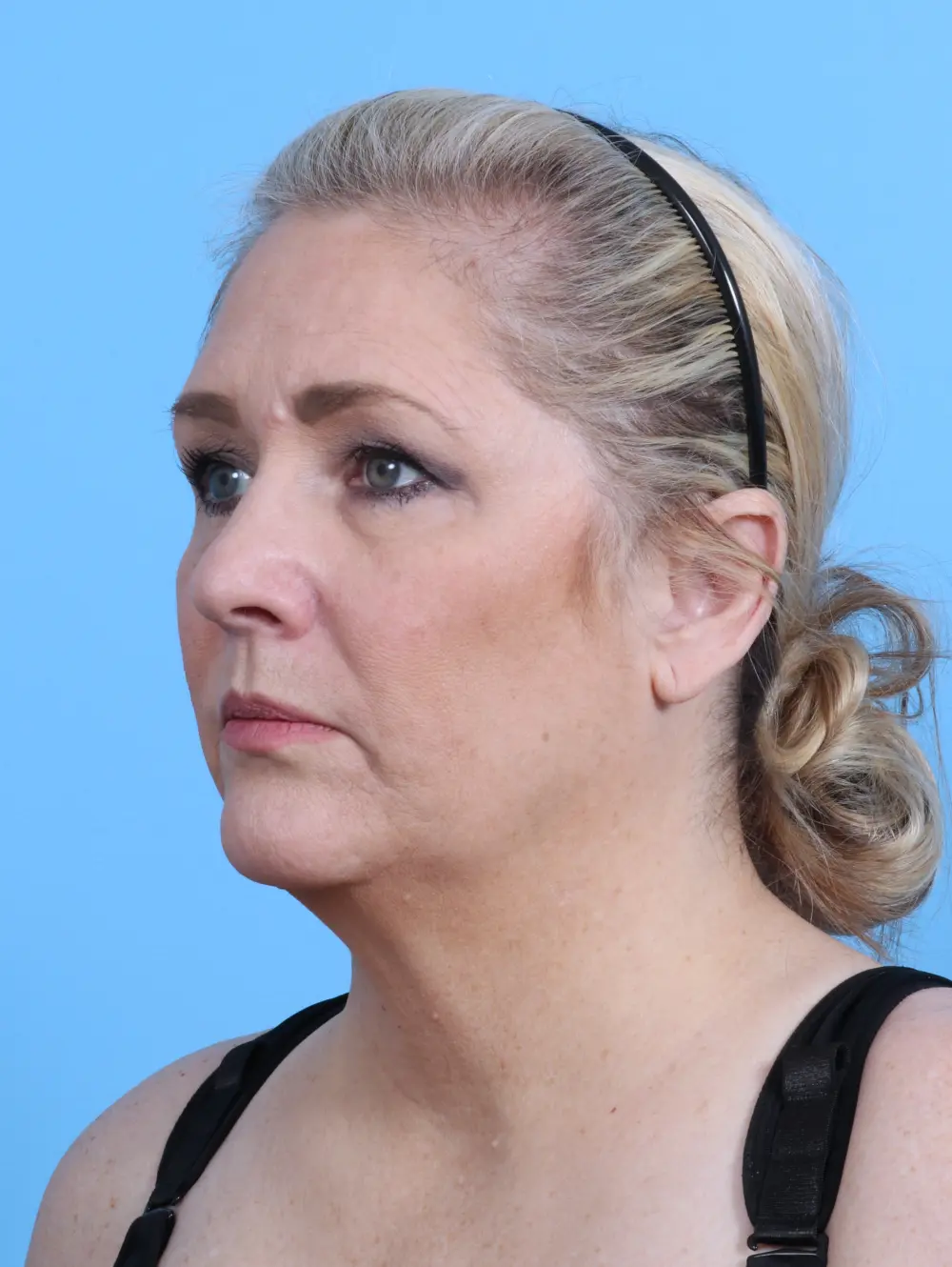 Rhinoplasty Patient Photo - Case 28526 - before view-1