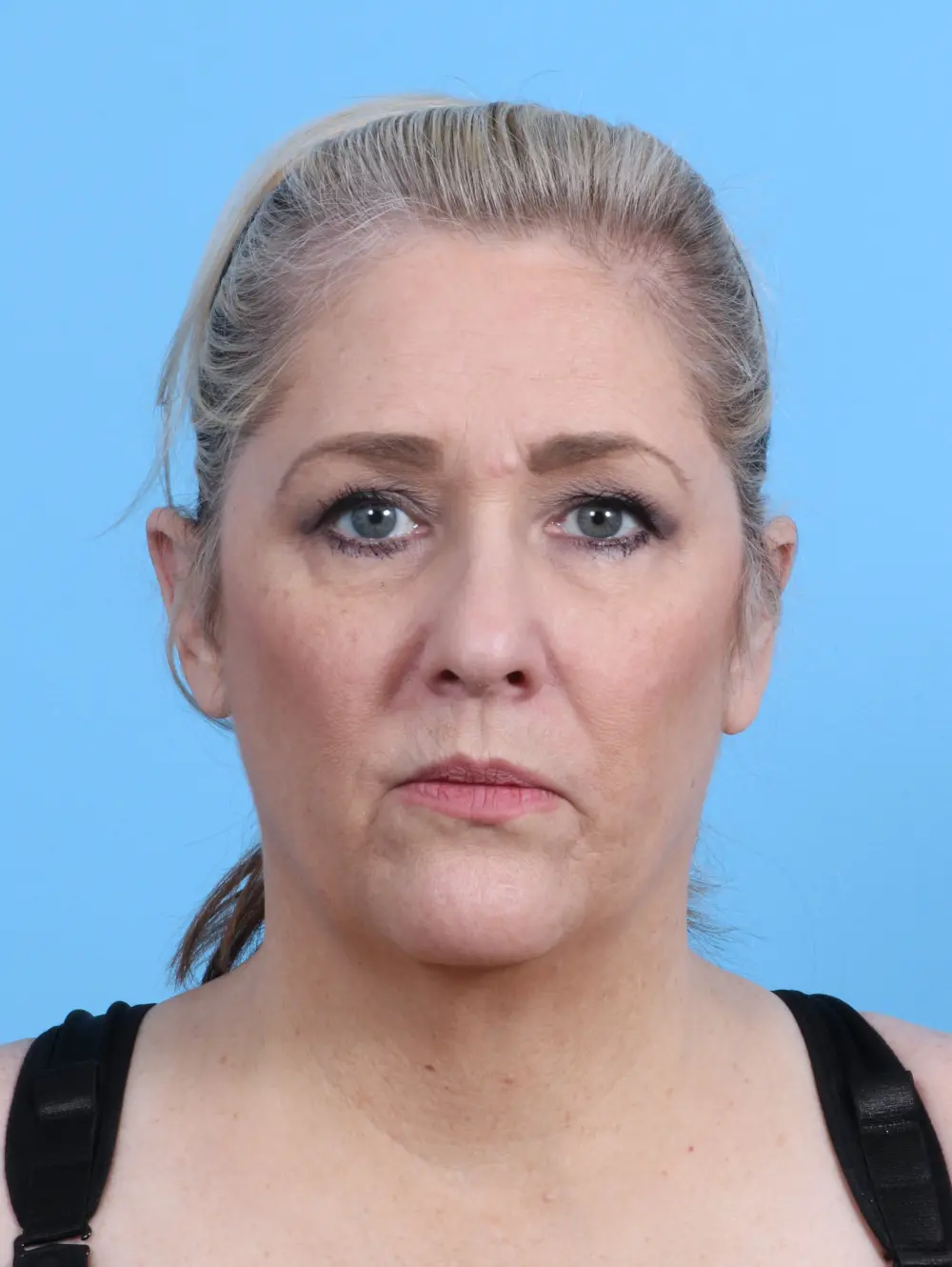 Rhinoplasty Patient Photo - Case 28526 - before view-2