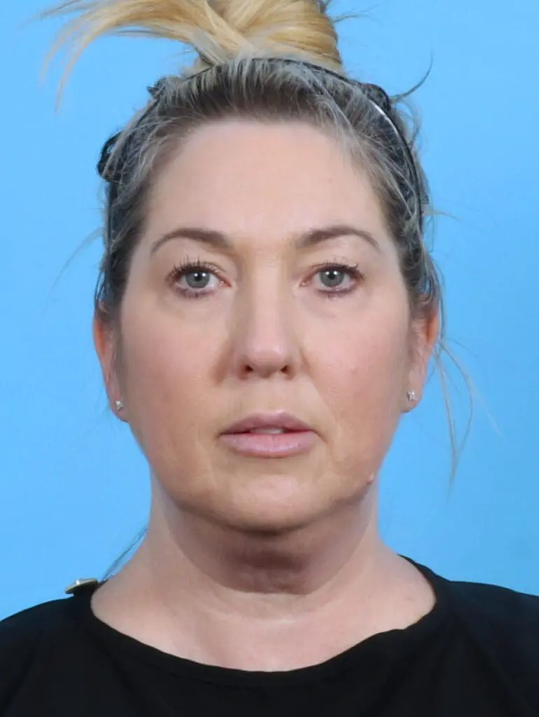 Eyelid Surgery - Case 28558 - Before