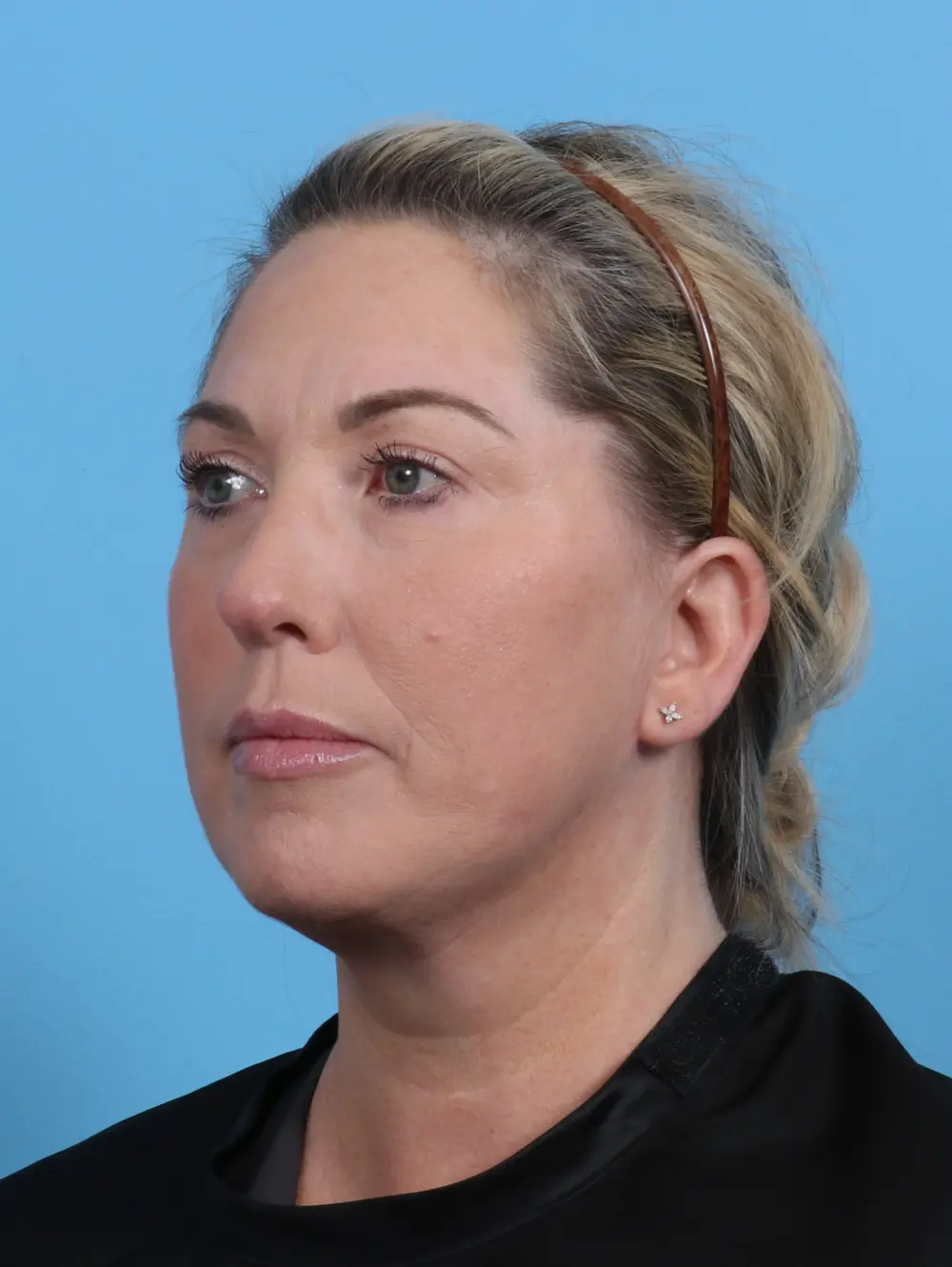 Eyelid Surgery Patient Photo - Case 28558 - after view-1