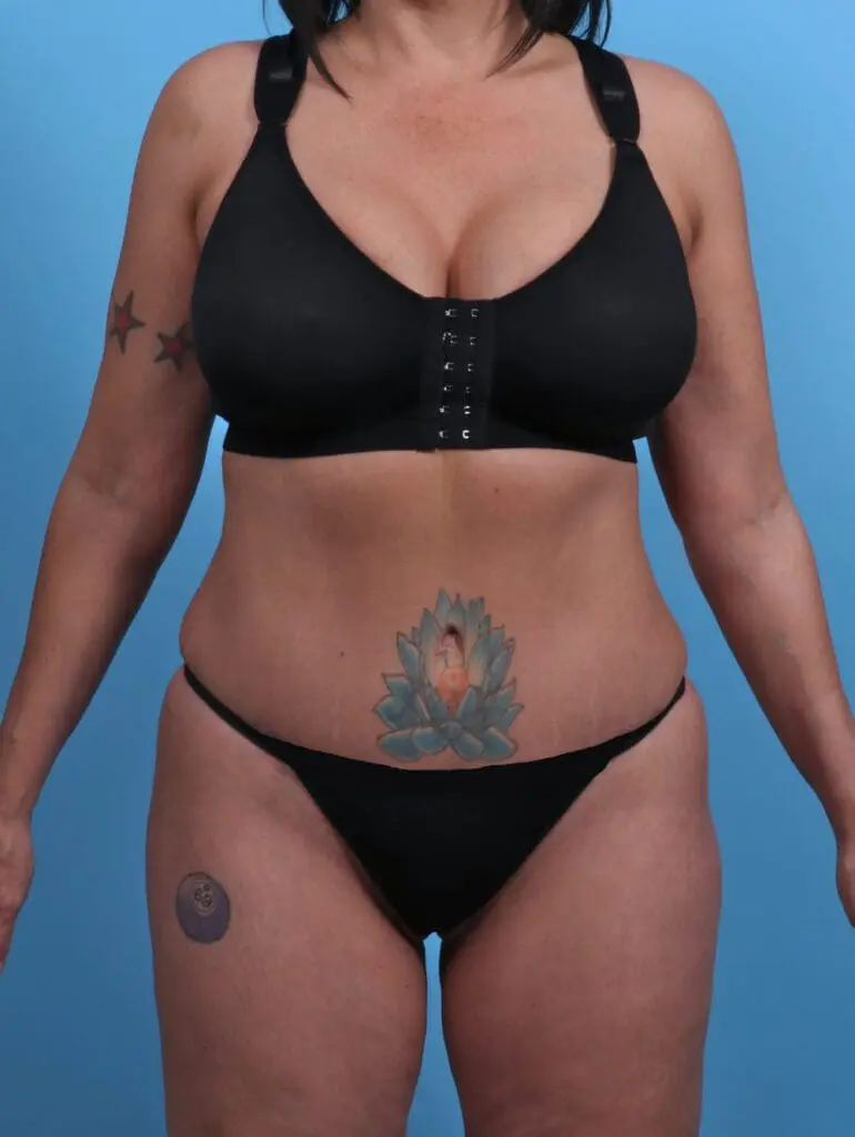 Tummy Tuck - Case 28601 - After