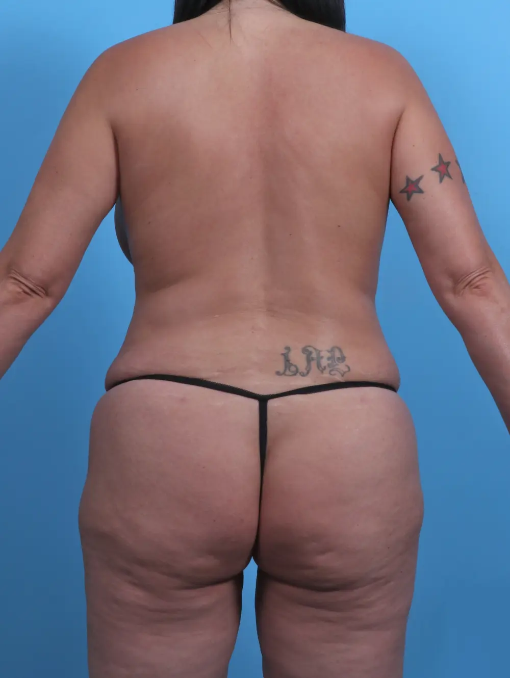 Tummy Tuck Patient Photo - Case 28601 - after view-3