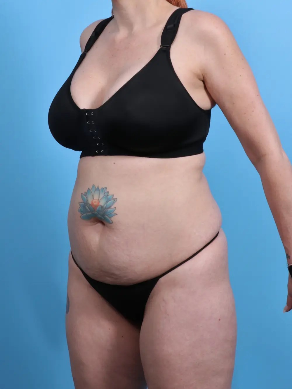 Tummy Tuck Patient Photo - Case 28601 - before view-1