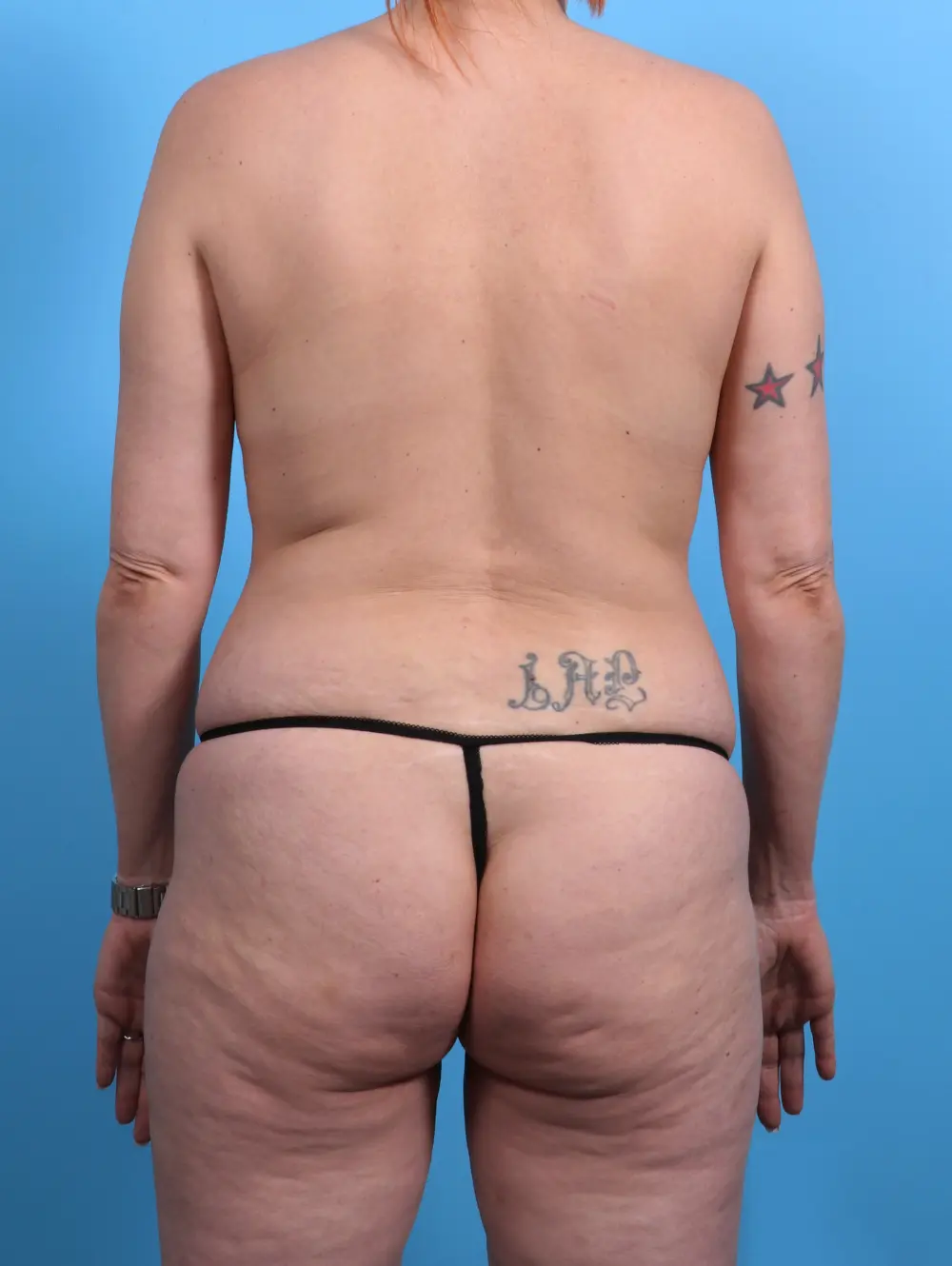 Tummy Tuck Patient Photo - Case 28601 - before view-3