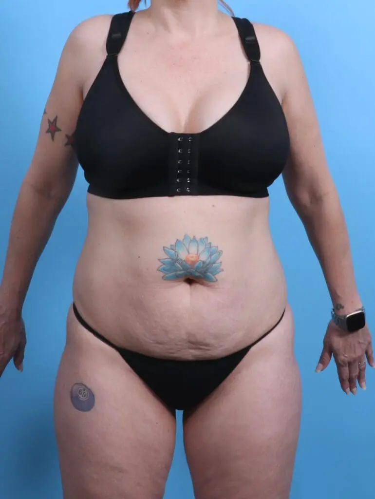 Tummy Tuck - Case 28601 - Before