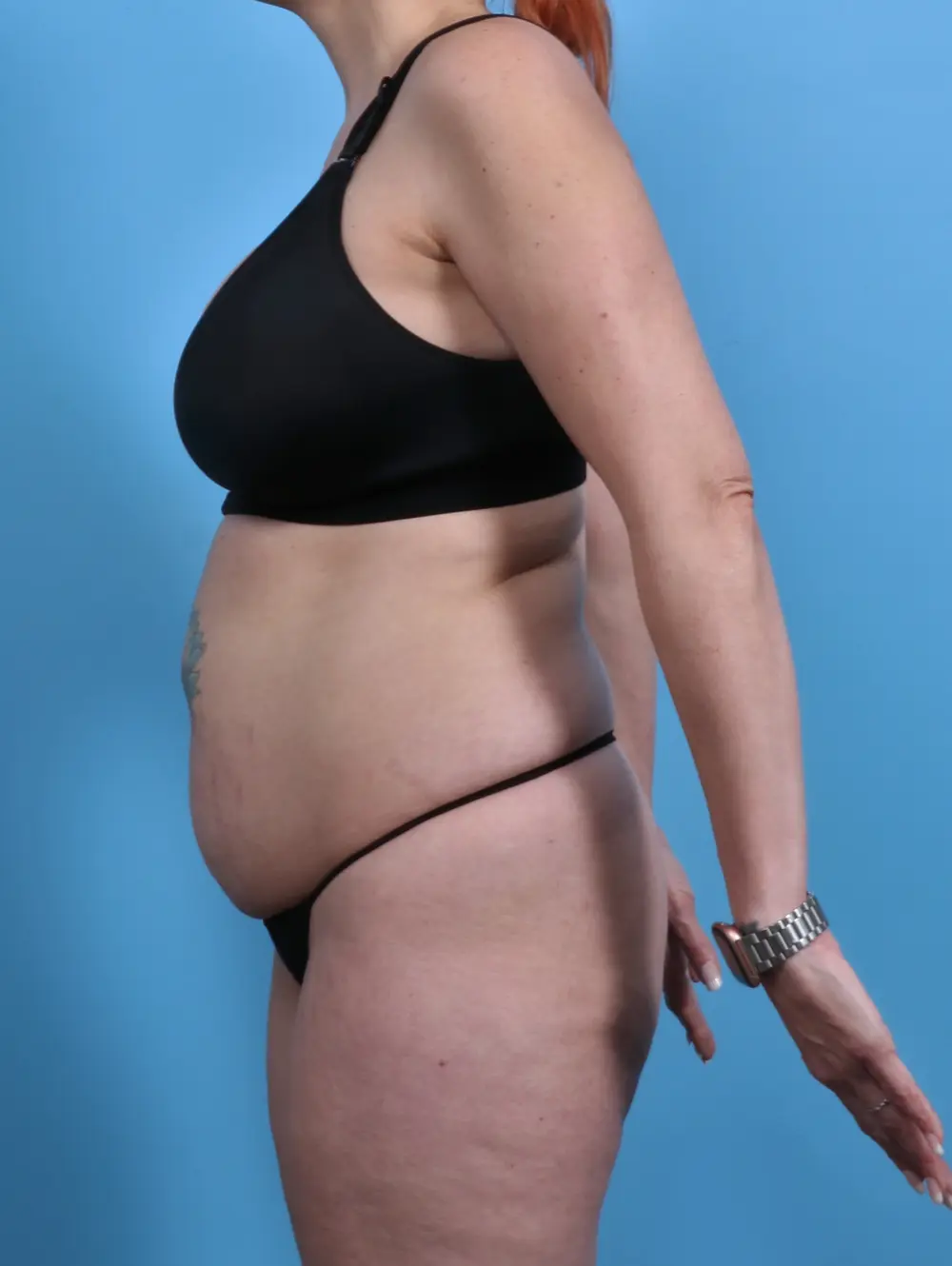 Tummy Tuck Patient Photo - Case 28601 - before view-2