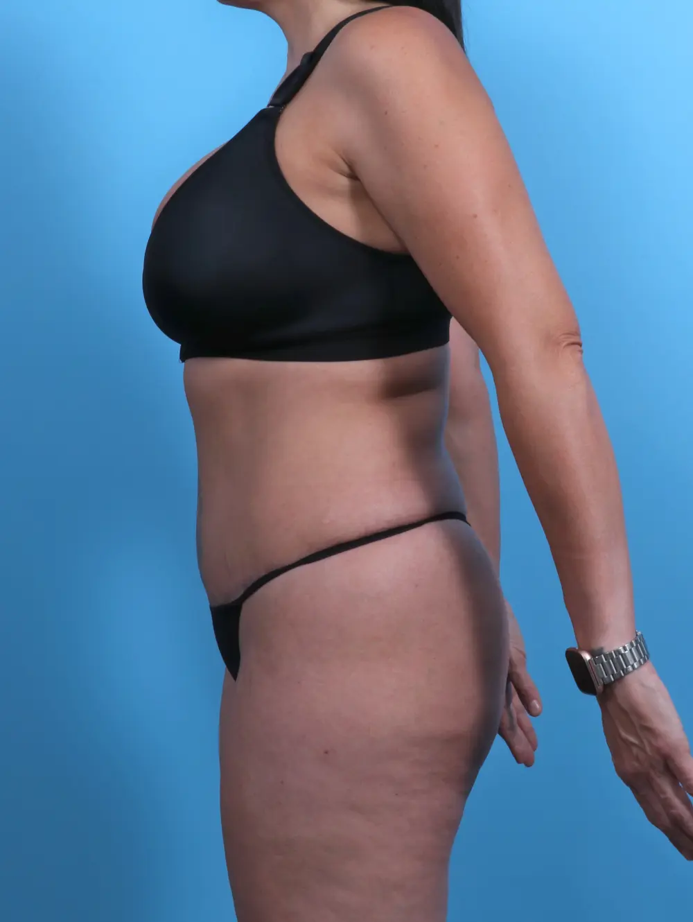 Tummy Tuck Patient Photo - Case 28601 - after view-2