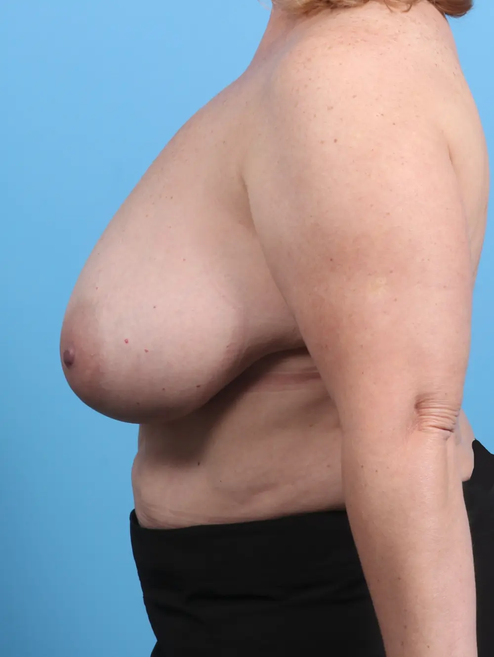 Breast Lift/Reduction w/o Implants Patient Photo - Case 28635 - before view-2