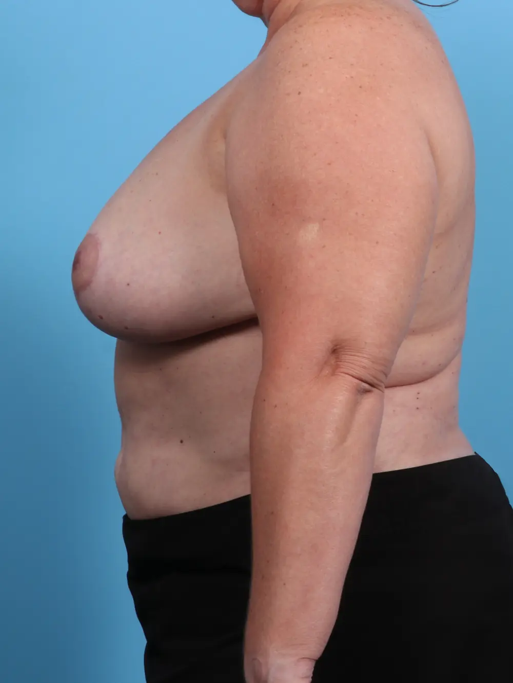 Breast Lift/Reduction w/o Implants Patient Photo - Case 28635 - after view-2