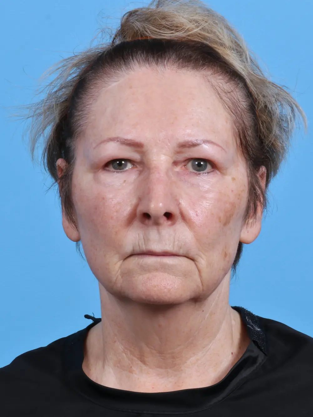 Before CO2 Laser Resurfacing