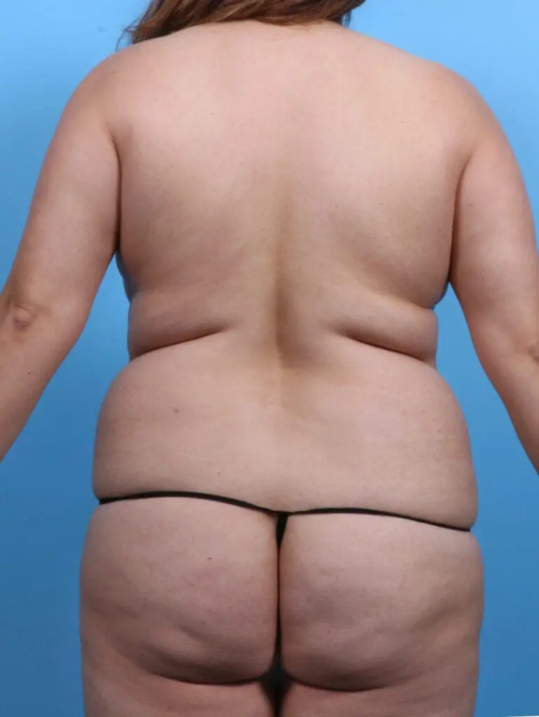 Brazilian Butt Lift - Case 28659 - Before