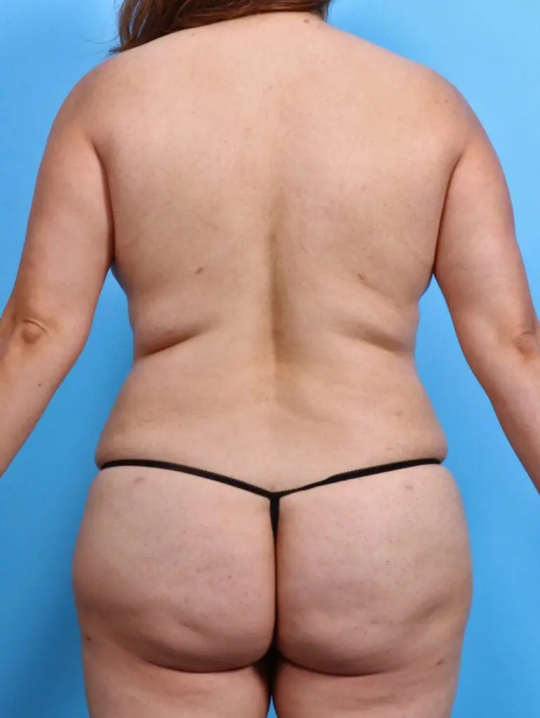 Brazilian Butt Lift - Case 28659 - After