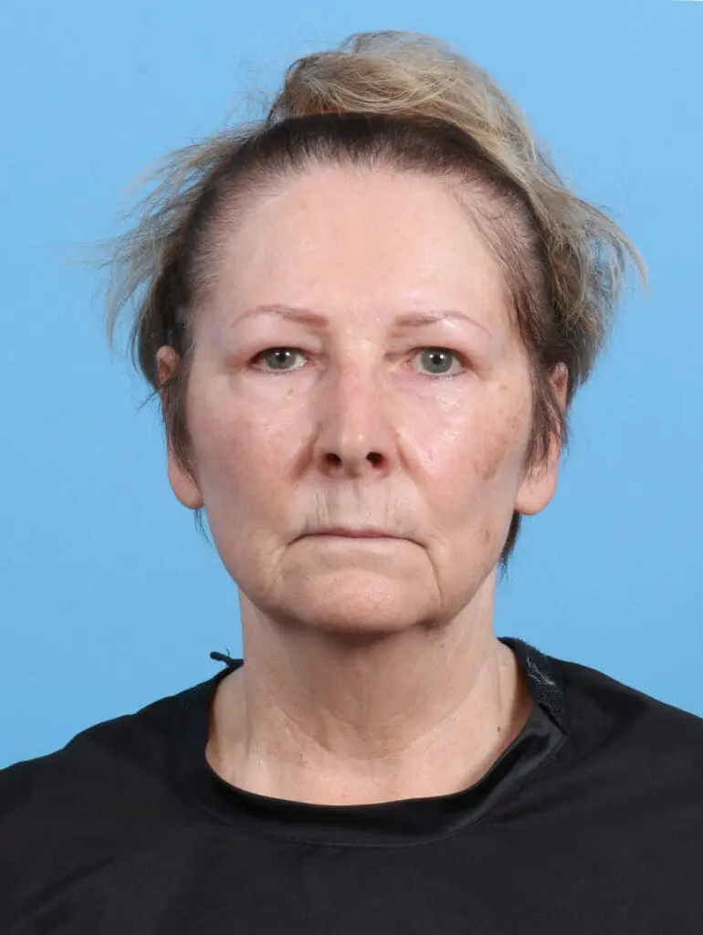 Bullhorn Lip Lift - Case 28651 - Before