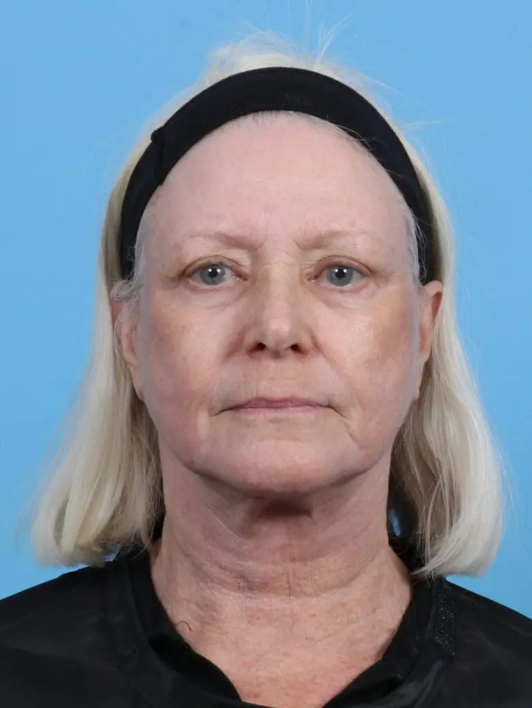 Eyelid Surgery - Case 28681 - After