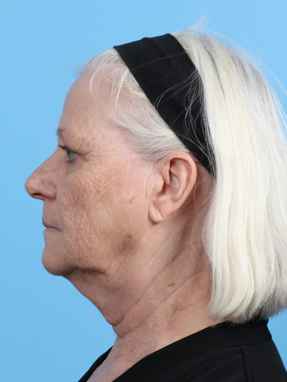 Eyelid Surgery Patient Photo - Case 28681 - before view-2