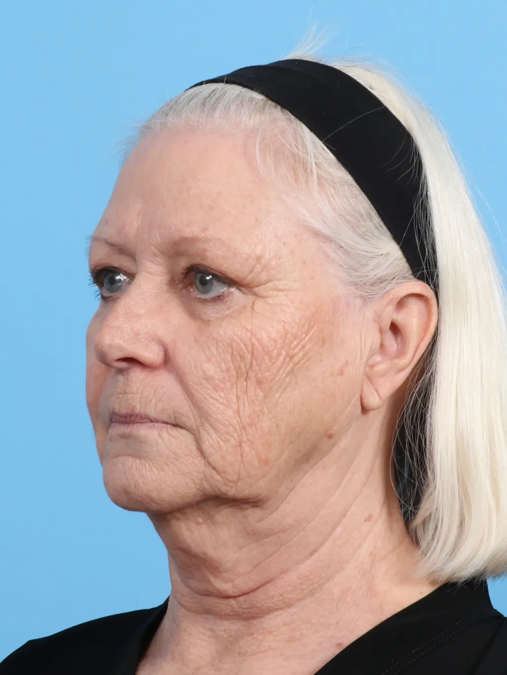 Eyelid Surgery Patient Photo - Case 28681 - before view-1