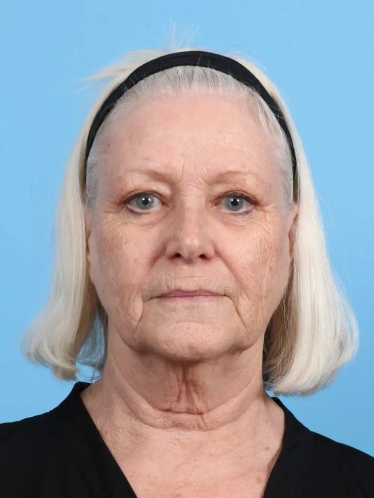 Eyelid Surgery - Case 28681 - Before