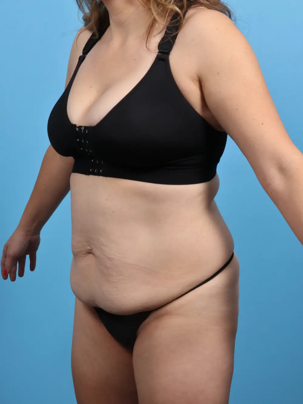Tummy Tuck Patient Photo - Case 28697 - before view-1