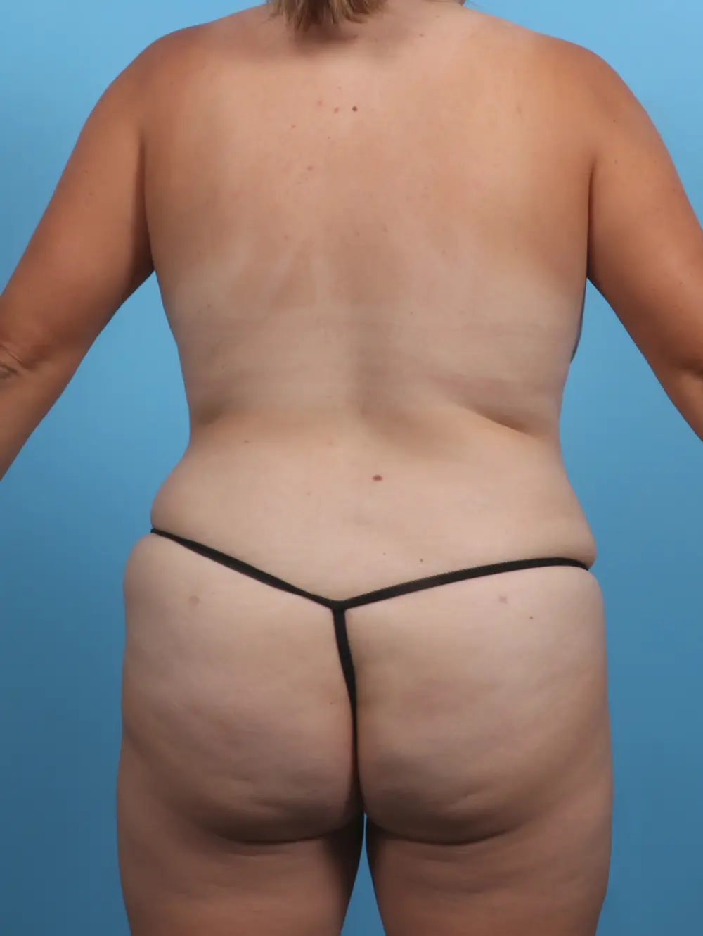Tummy Tuck Patient Photo - Case 28697 - after view-3