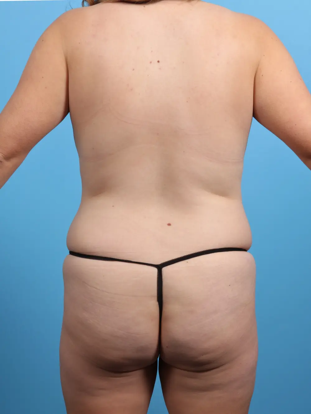 Tummy Tuck Patient Photo - Case 28697 - before view-3
