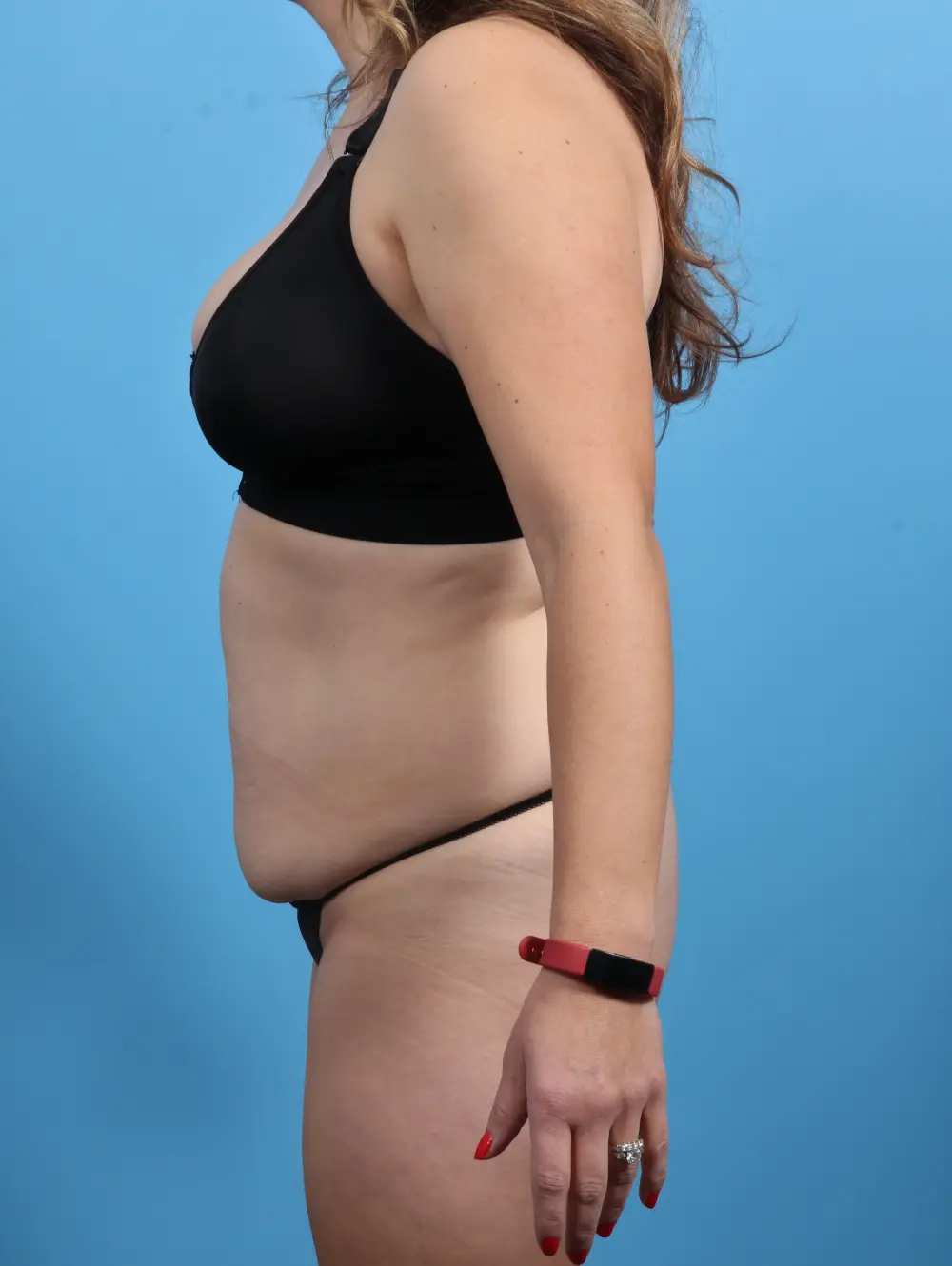 Tummy Tuck Patient Photo - Case 28697 - before view-2