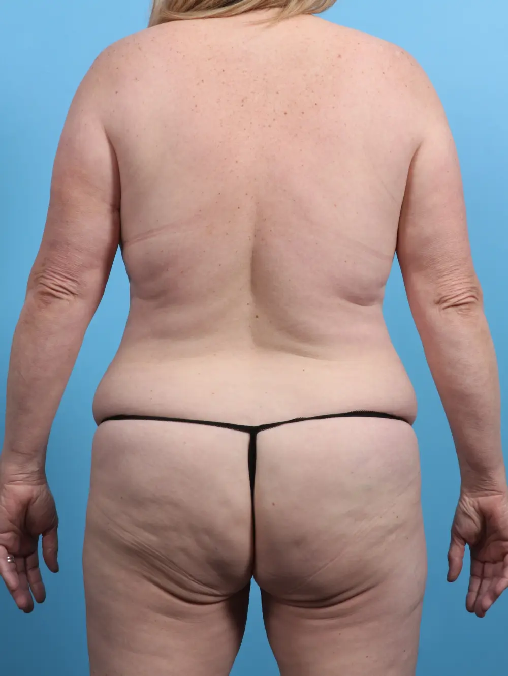 Breast Lift/Reduction w/o Implants Patient Photo - Case 28749 - before view-3