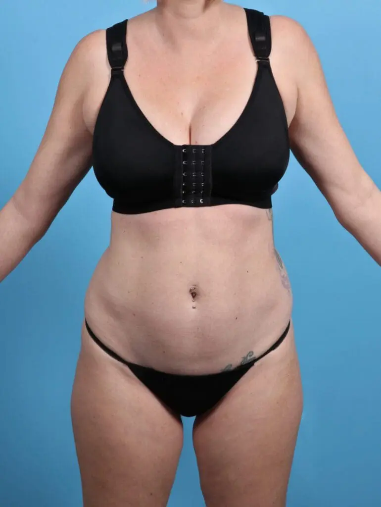 Tummy Tuck - Case 28775 - Before