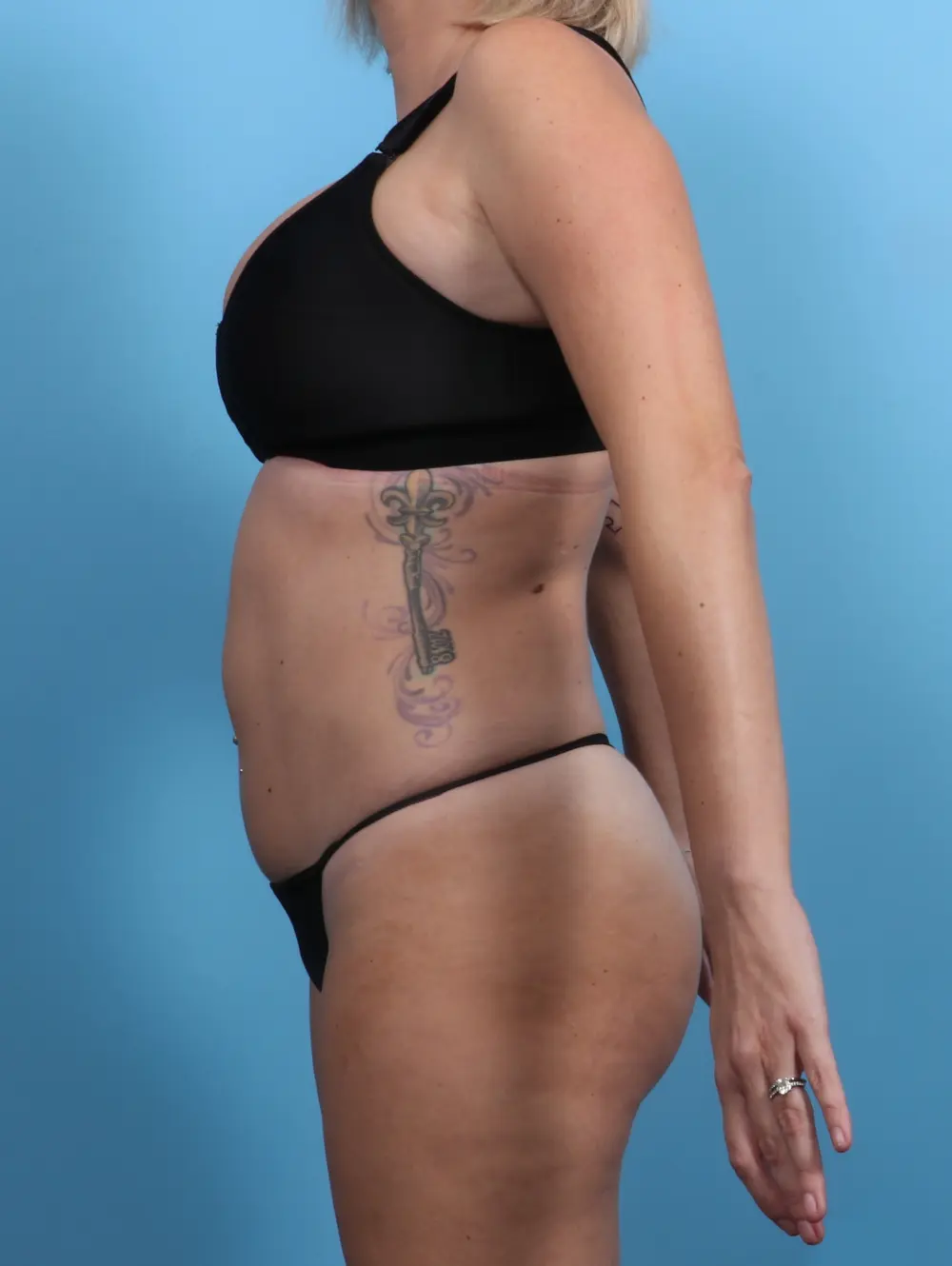 Tummy Tuck Patient Photo - Case 28775 - after view-2
