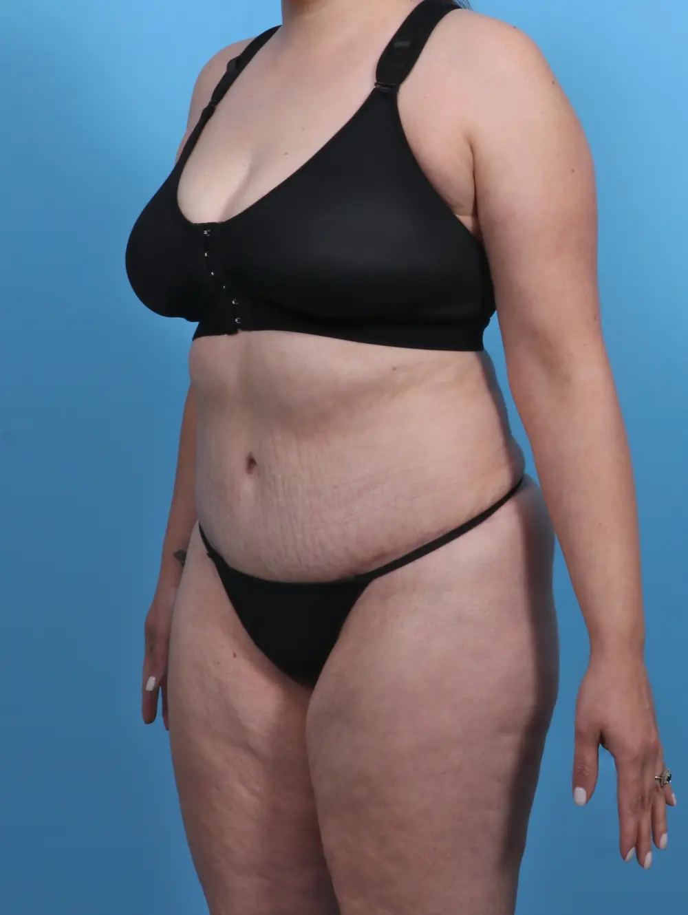 Tummy Tuck Patient Photo - Case 28801 - after view-1