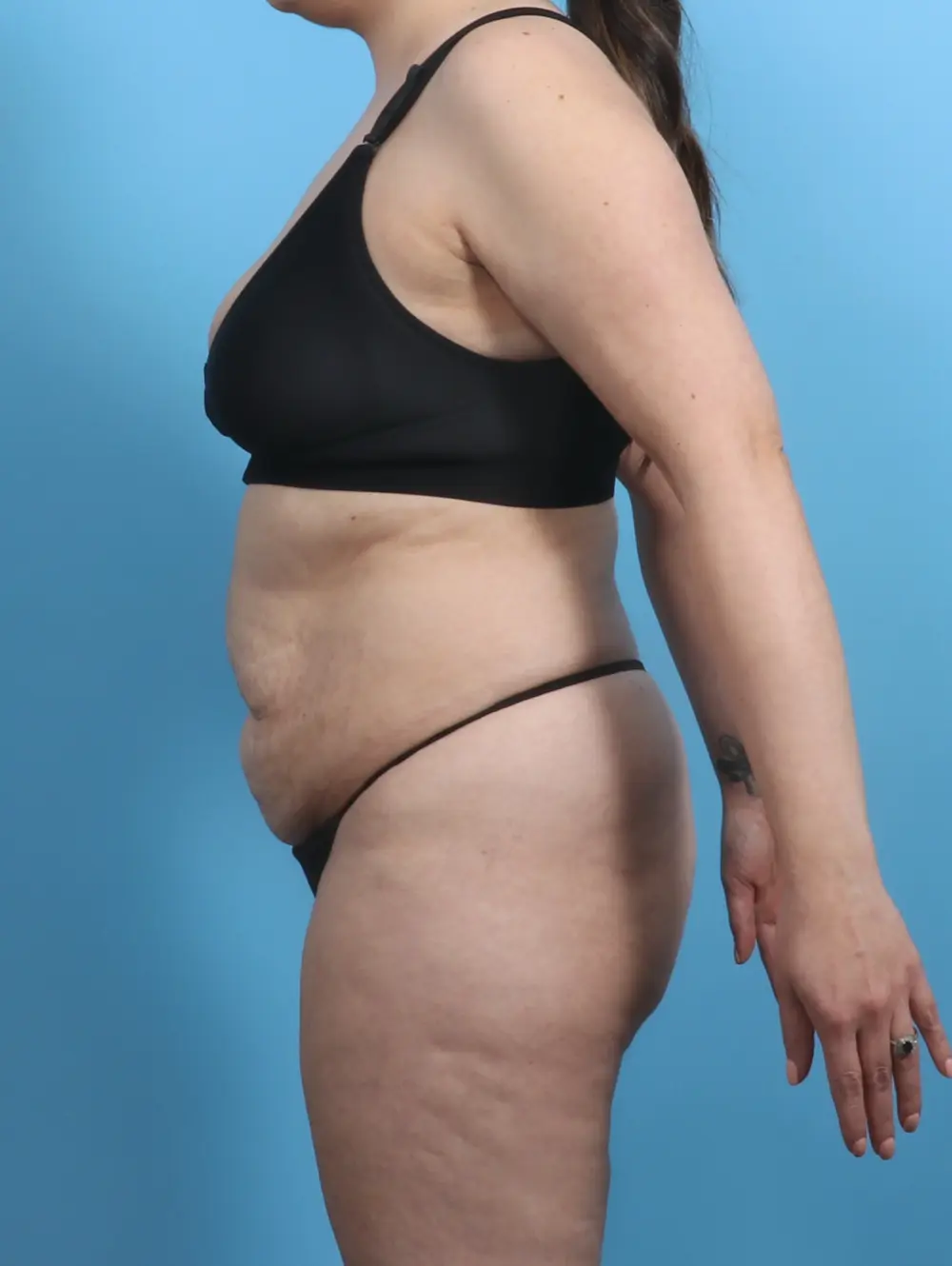 Tummy Tuck Patient Photo - Case 28801 - before view-2
