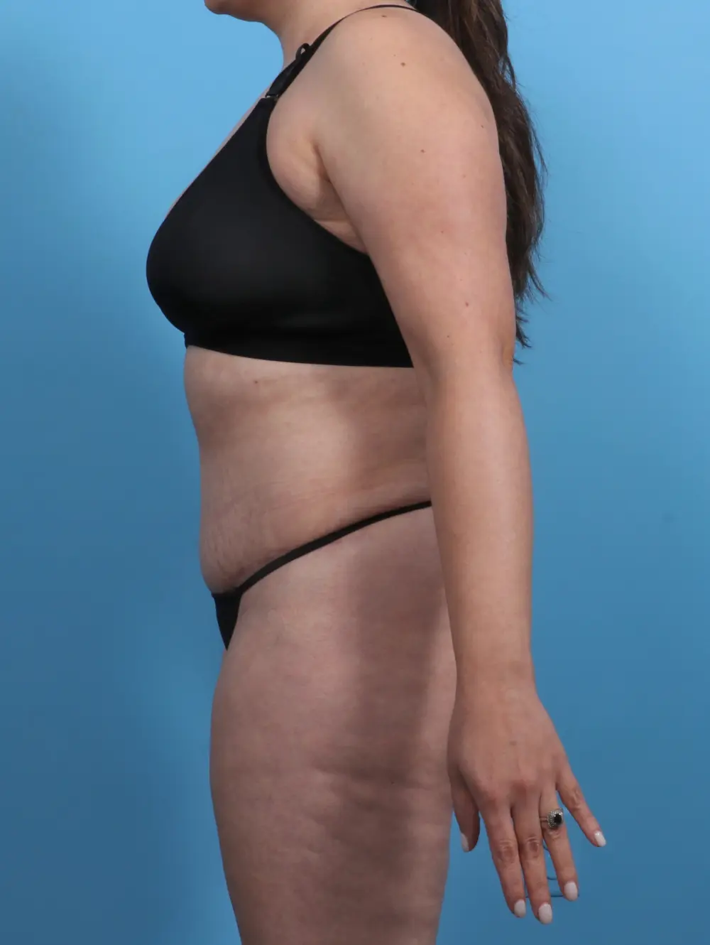 Tummy Tuck Patient Photo - Case 28801 - after view-2