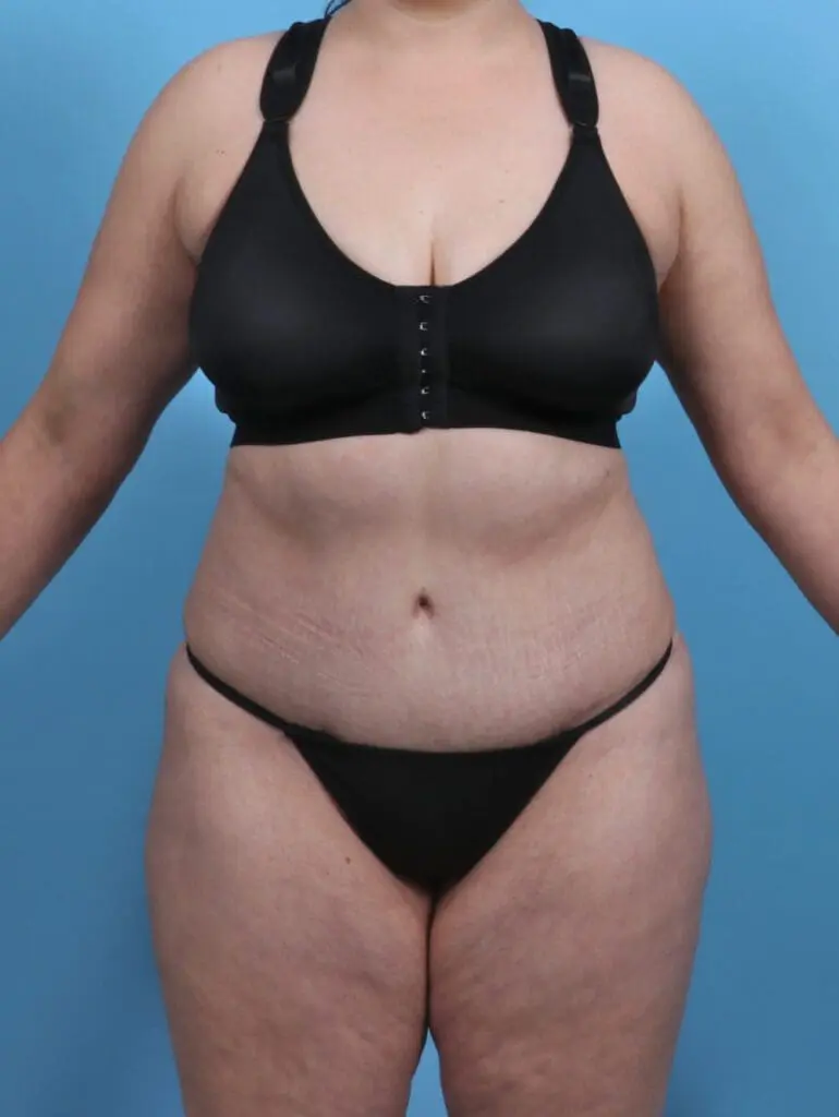 Tummy Tuck - Case 28801 - After