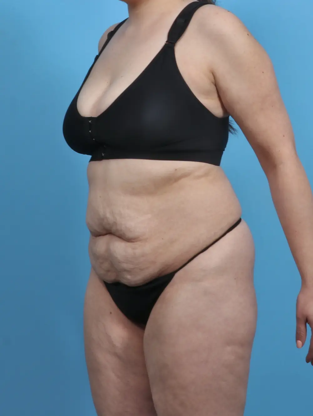 Tummy Tuck Patient Photo - Case 28801 - before view-1