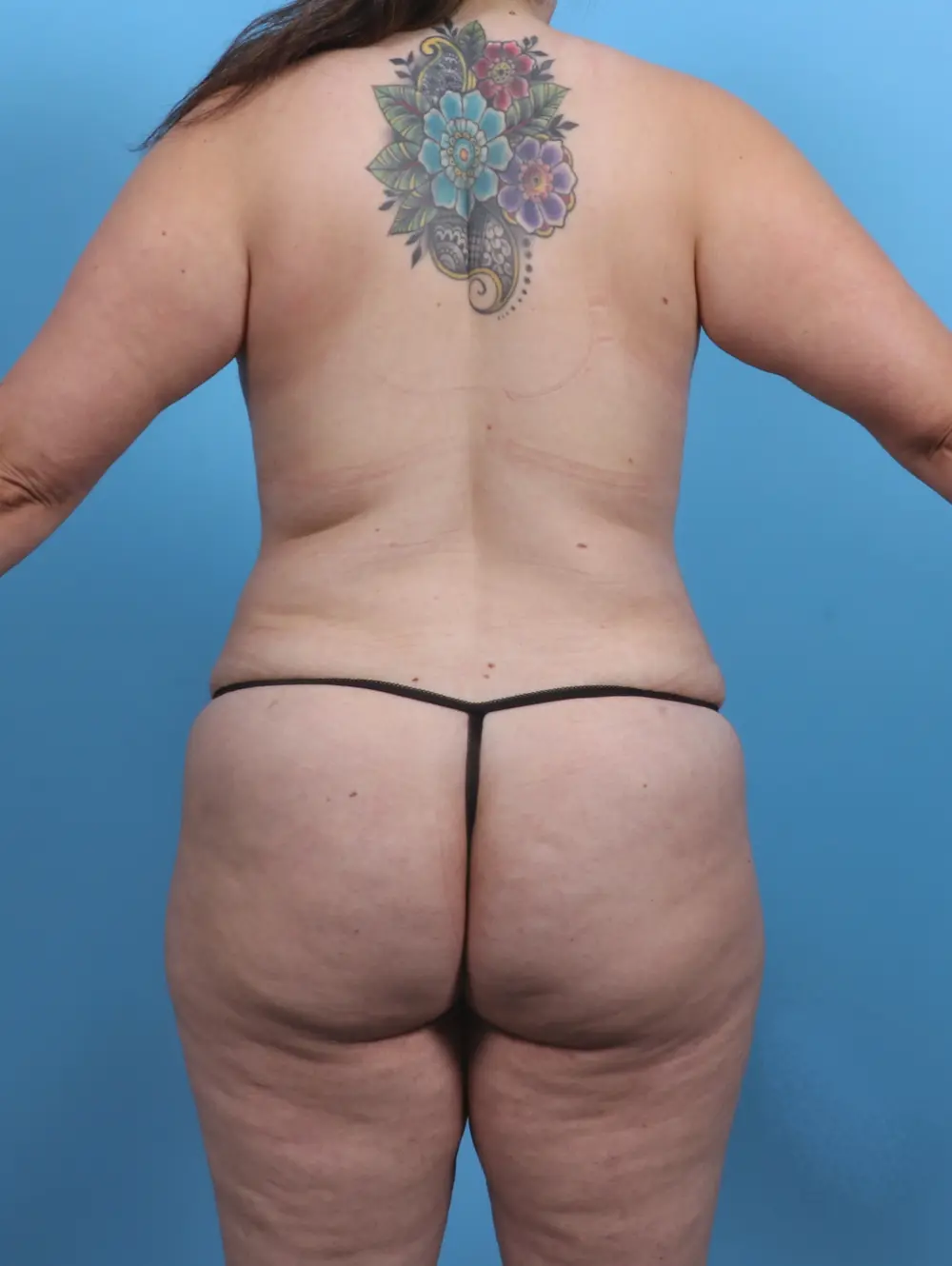 Tummy Tuck Patient Photo - Case 28801 - after view-3