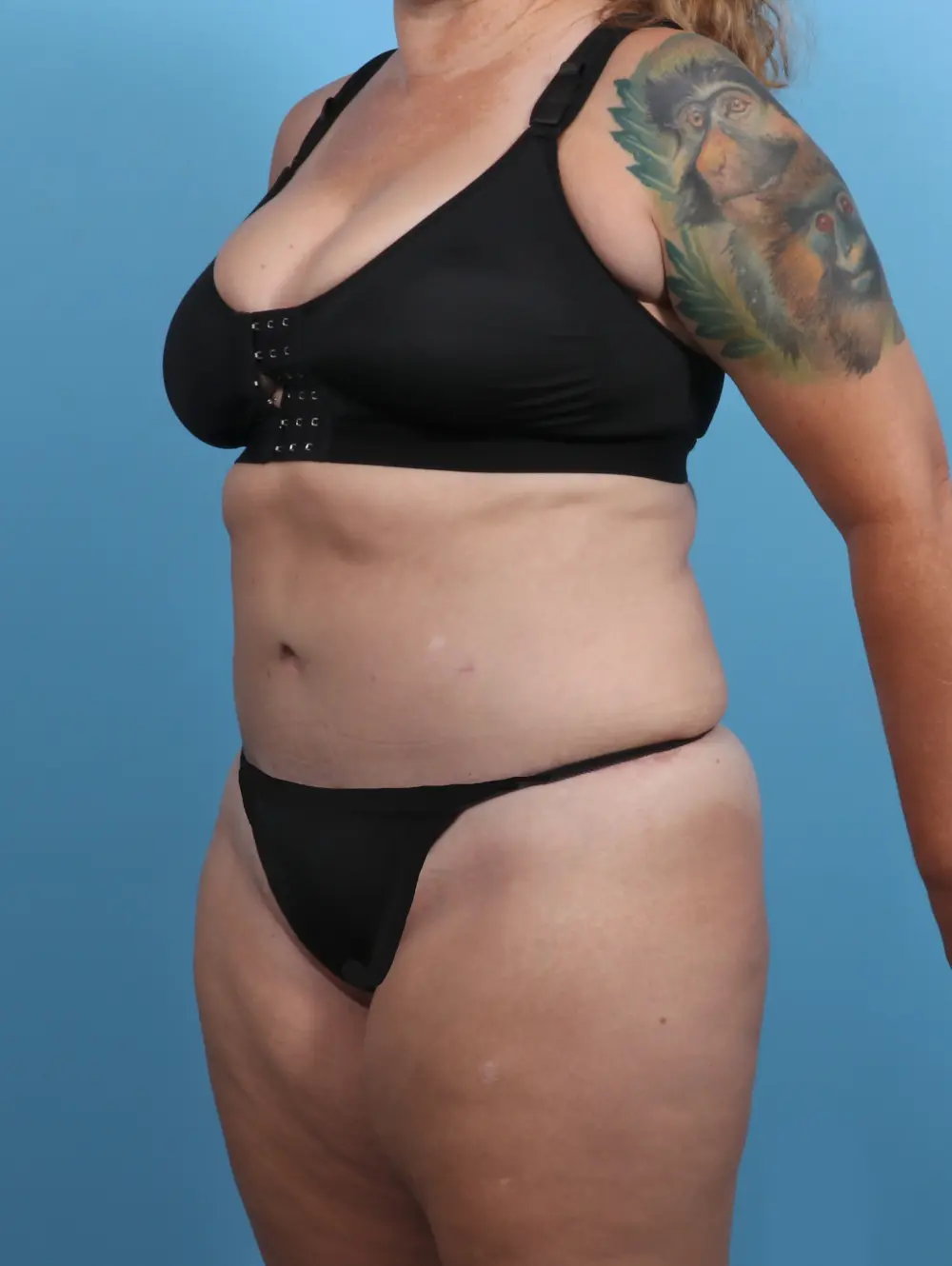 Tummy Tuck Patient Photo - Case 28811 - after view-1
