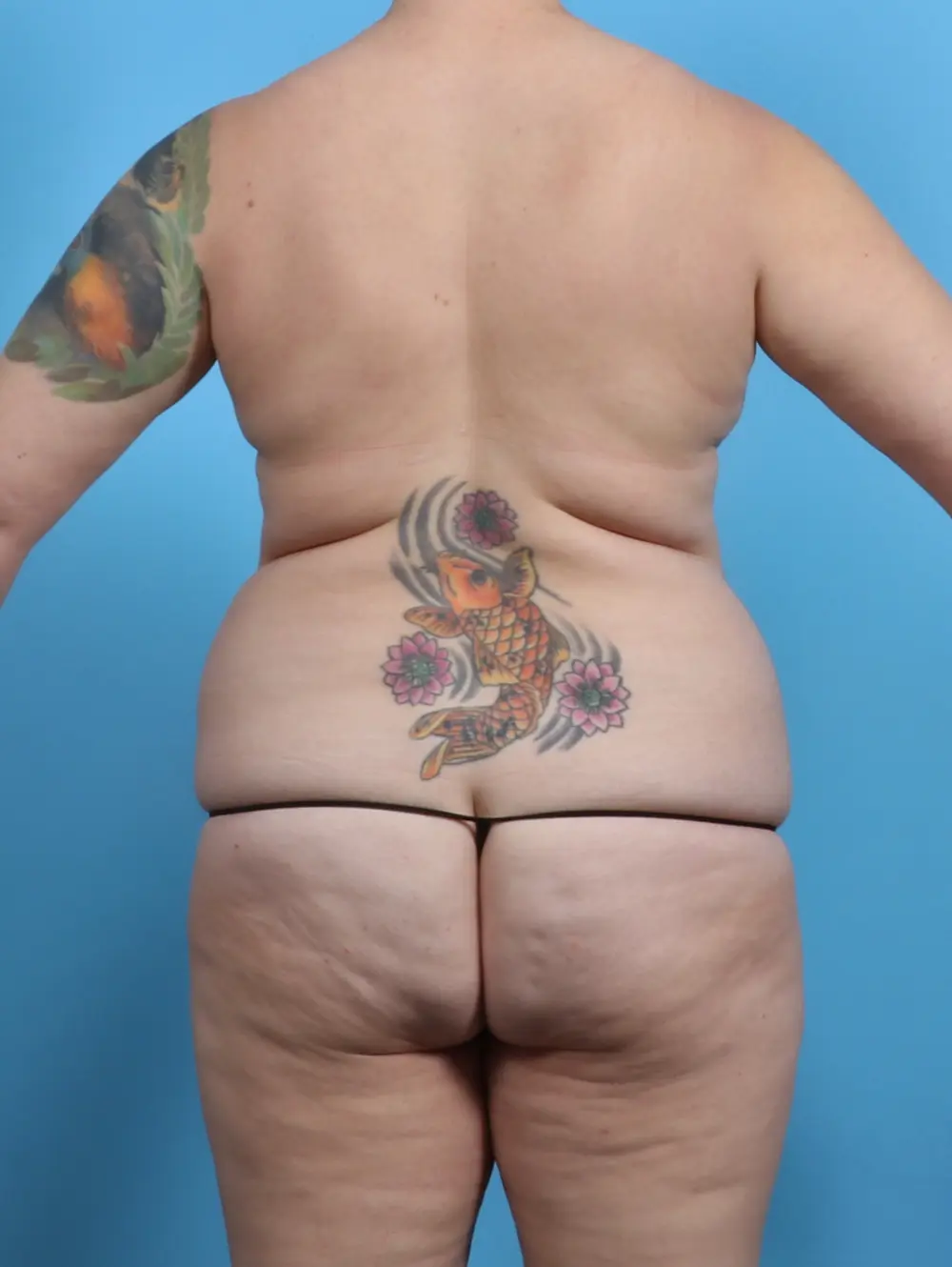 Tummy Tuck Patient Photo - Case 28811 - before view-3