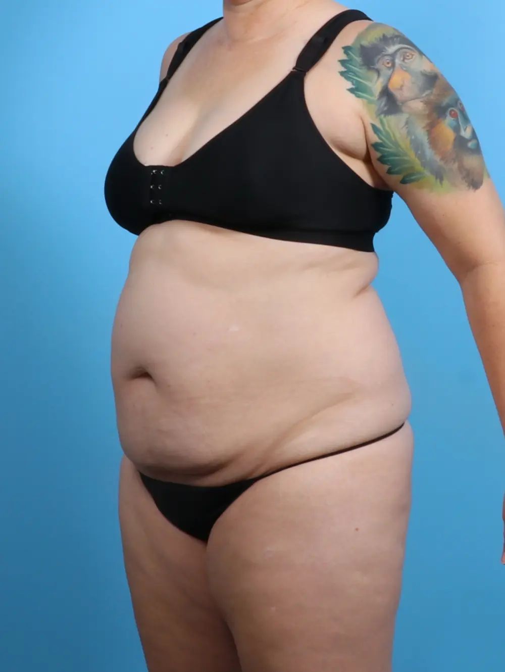 Tummy Tuck Patient Photo - Case 28811 - before view-1