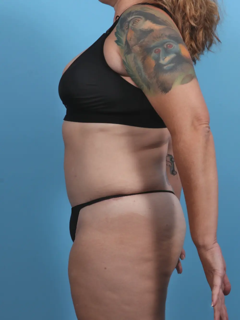 Tummy Tuck Patient Photo - Case 28811 - after view-2