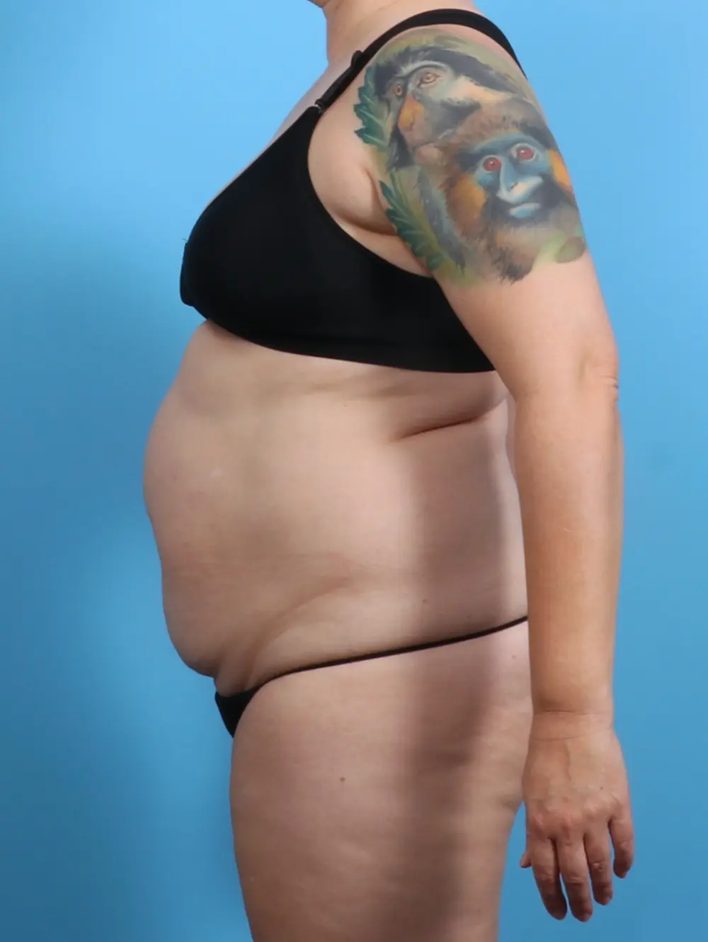 Tummy Tuck Patient Photo - Case 28811 - before view-2