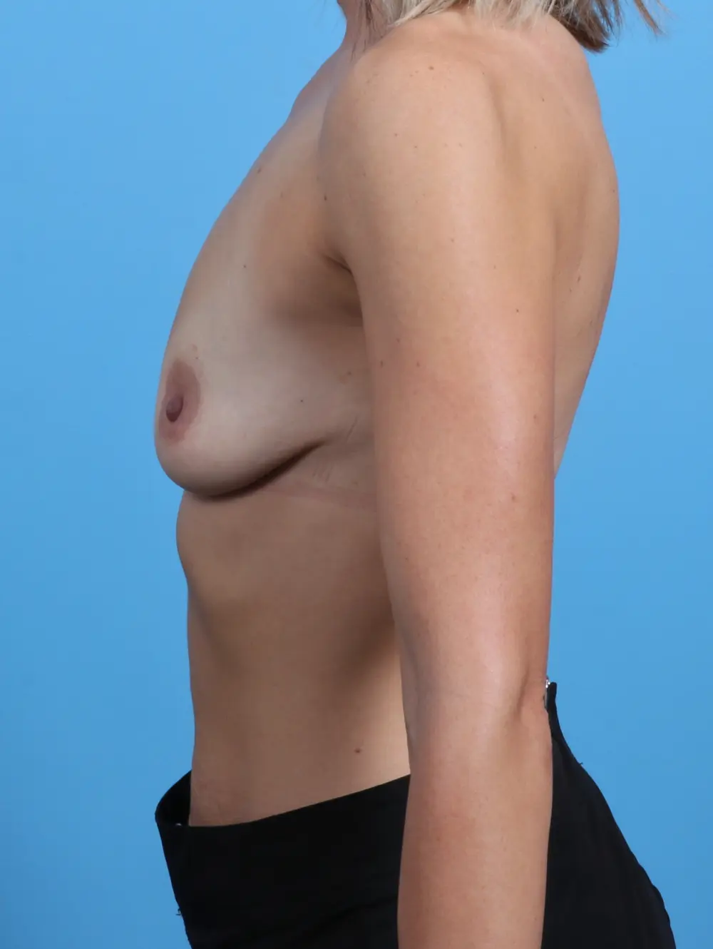 Breast Lift/Reduction with Implants Patient Photo - Case 28821 - before view-2
