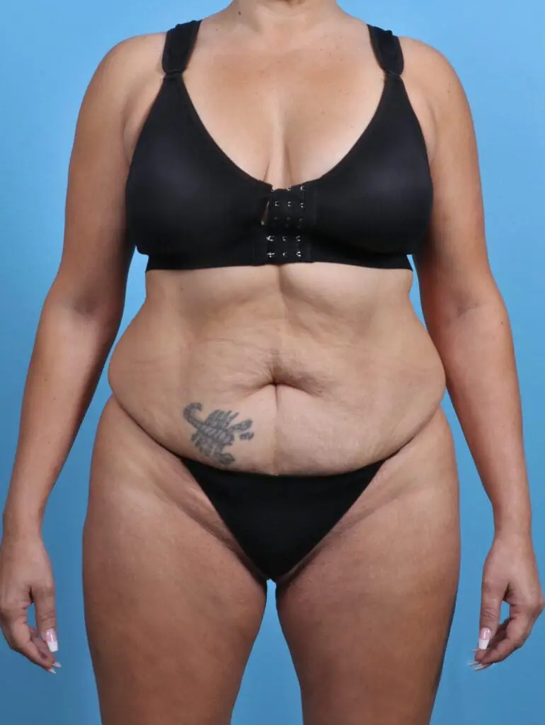 Tummy Tuck - Case 28845 - Before